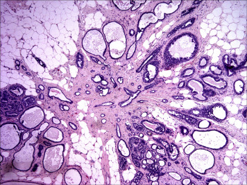 Radial Scars