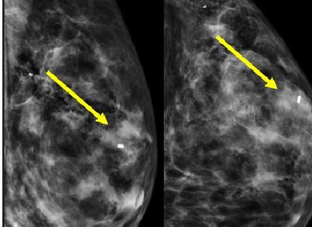 Fibroadenomas