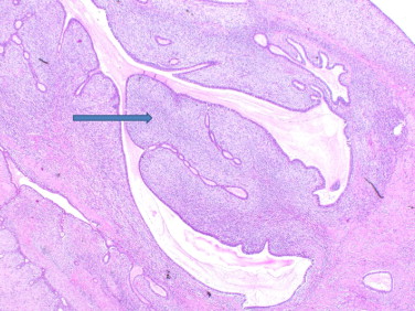Phyllodes Tumours