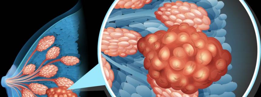 Breast Cysts