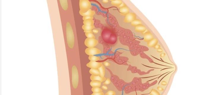Ductal Carcinoma in Situ