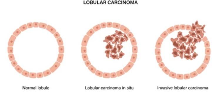 Lobular carcinoma in situ